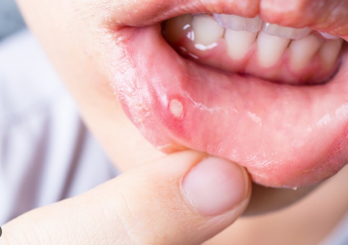 Read more about the article Canker Sores: Types, Symptoms, and Treatments